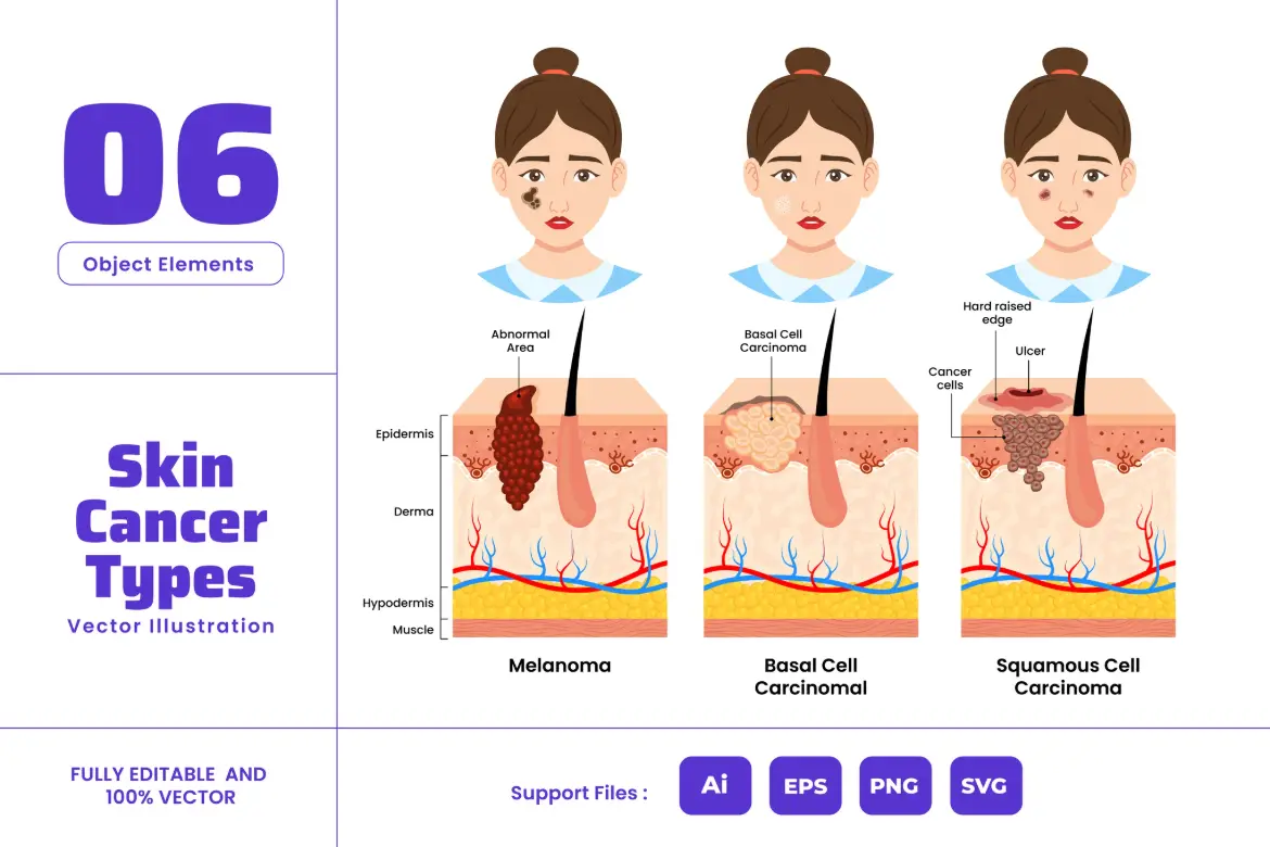 皮肤癌类型医学教育矢量海报插图AI/EPS/SVG/PNG黑色素瘤科普设计素材