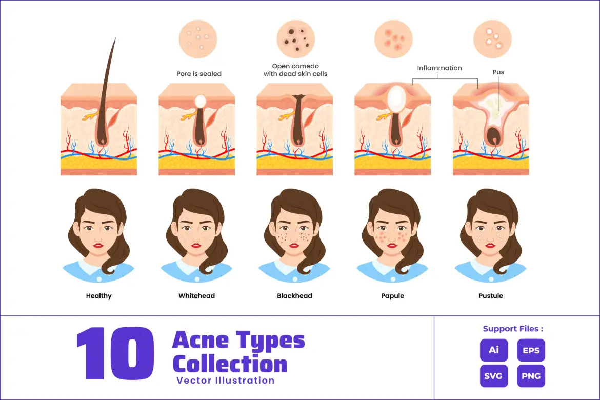 痤疮类型皮肤毛孔结构医学图解AI/EPS/SVG/PNG粉刺痘痘海报素材